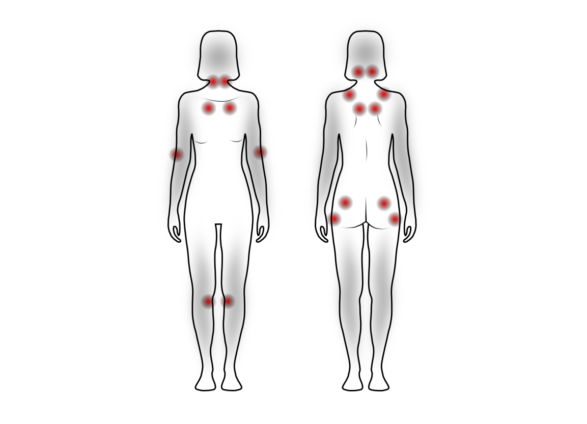 ¿Cómo se diagnostica la fibromialgia&nbsp;actualmente?